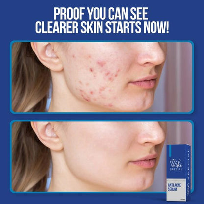 🌿✨ Wiki Special Anti Acne Serum – 30ml